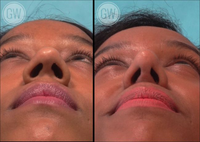 Alarplasty - Rhinoplastyperth