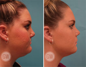 Rhinoplasty + Septoplasty + Reduction Genioplasty + Upper lip fat grafting