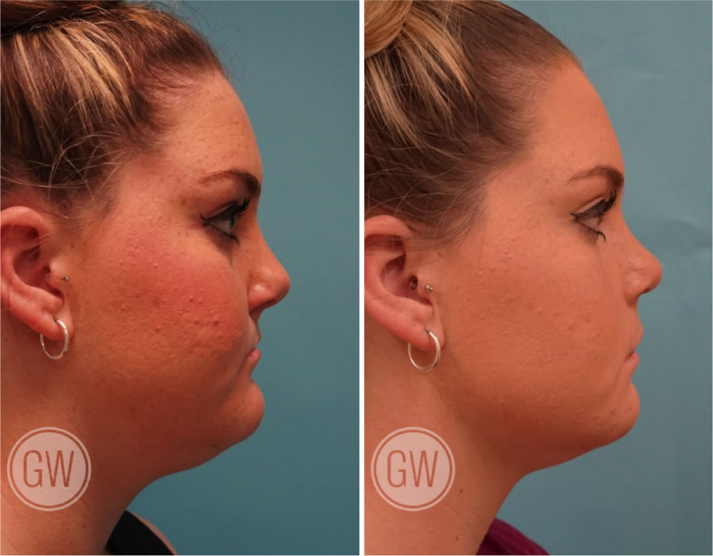 Rhinoplasty + Septoplasty + Reduction Genioplasty + Upper lip fat grafting