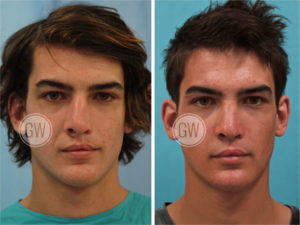 Cleft Rhinoplasty + Septoplasty