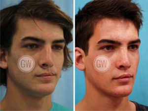 Cleft Rhinoplasty + Septoplasty