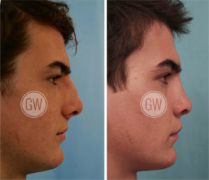 Cleft Rhinoplasty + Septoplasty