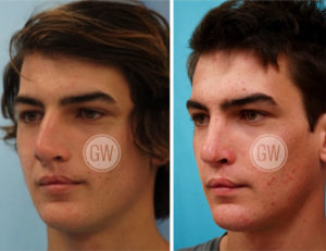 Cleft Rhinoplasty + Septoplasty