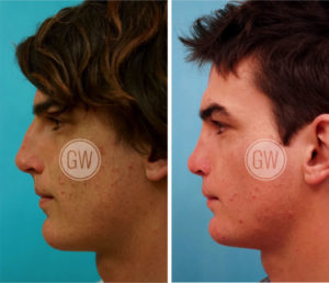 Cleft Rhinoplasty + Septoplasty