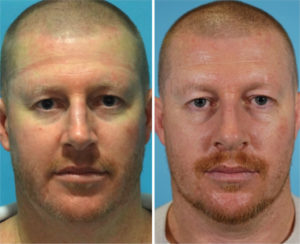 Rhinoplasty -Dorsal hump reduction + Septoplasty