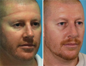 Rhinoplasty -Dorsal hump reduction + Septoplasty