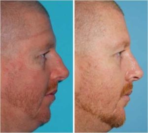 Rhinoplasty -Dorsal hump reduction + Septoplasty