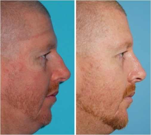 Rhinoplasty -Dorsal hump reduction + Septoplasty