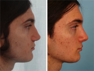 Rhinoplasty – Dorsal hump reduction + Septoplasty