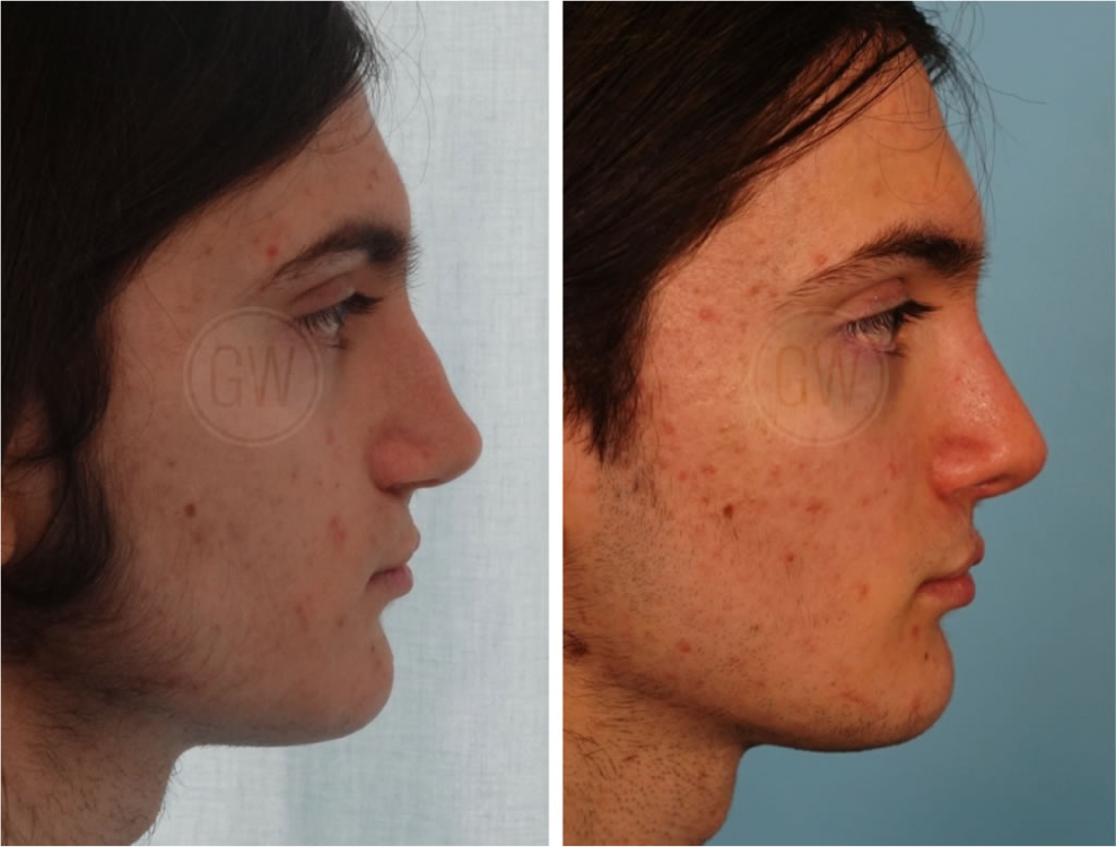 Rhinoplasty – Dorsal hump reduction + Septoplasty