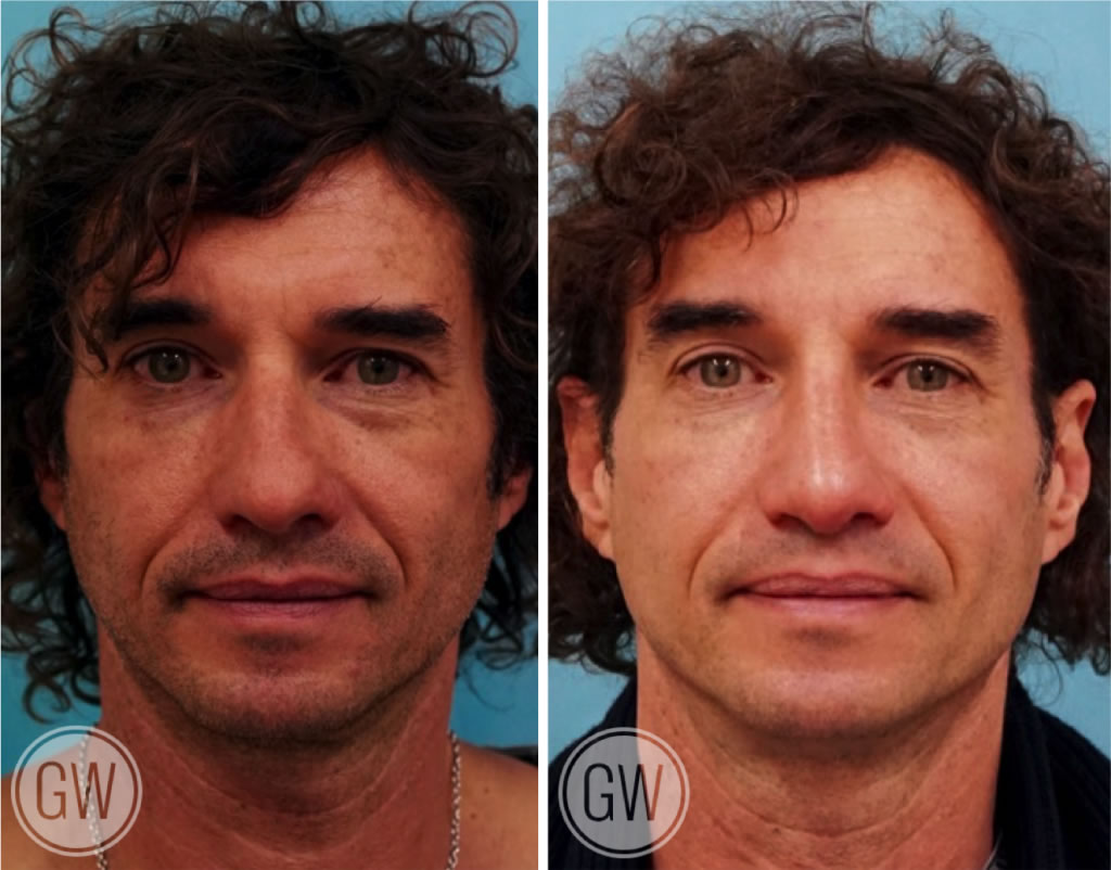 Reduction rhinoplasty