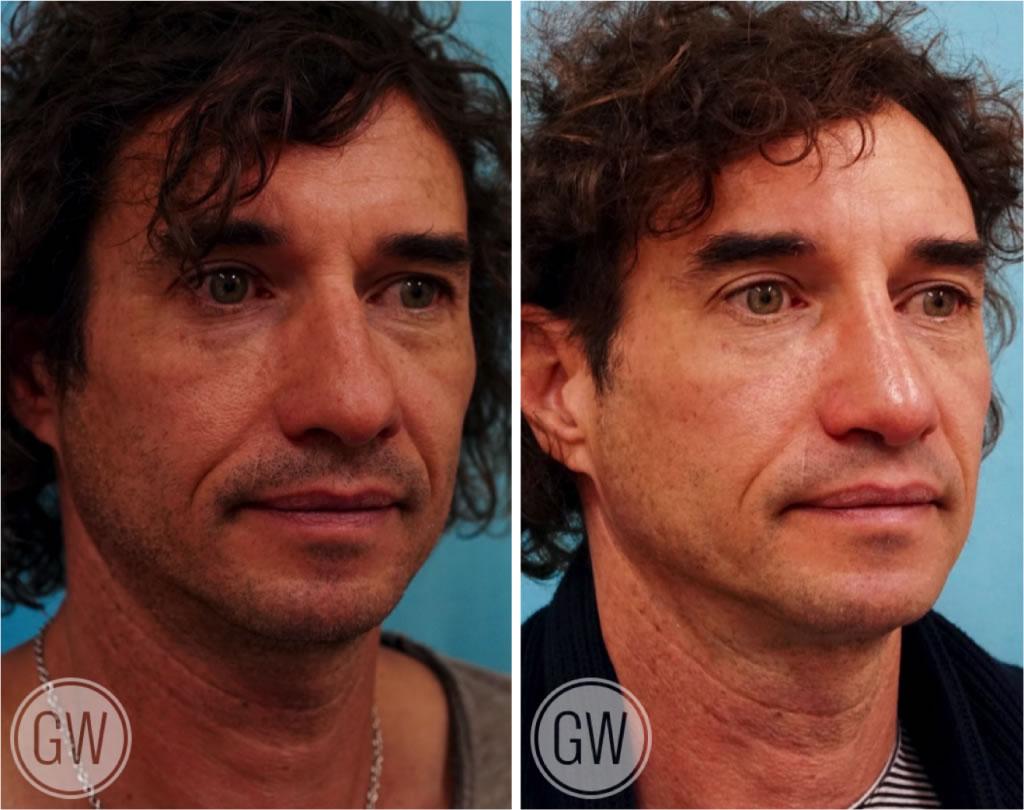 Reduction rhinoplasty