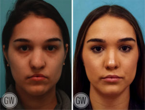 Cleft Rhinoplasty + Upper Lip Fat Grafting