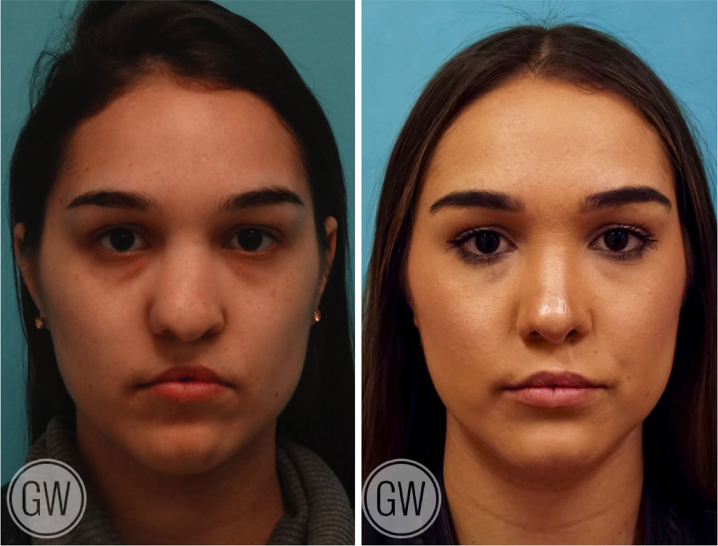 Cleft Rhinoplasty + Upper Lip Fat Grafting