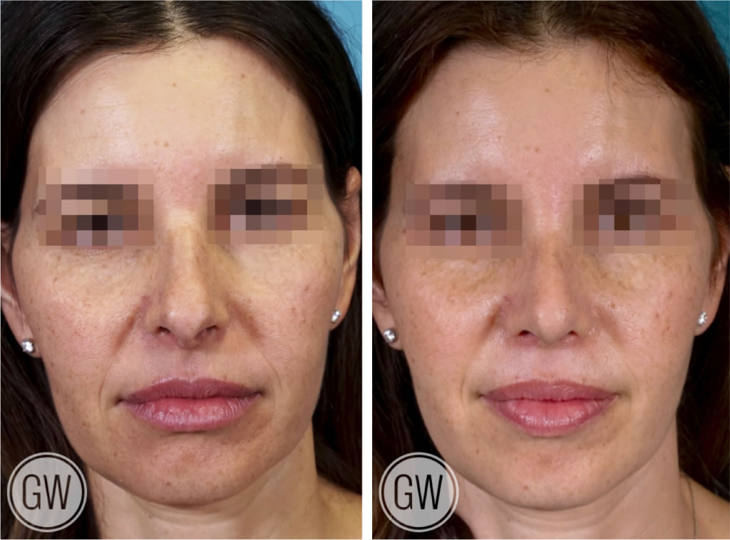 Rhinoplasty + Septoplasty