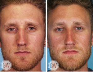Rhinoplasty + Septoplasty