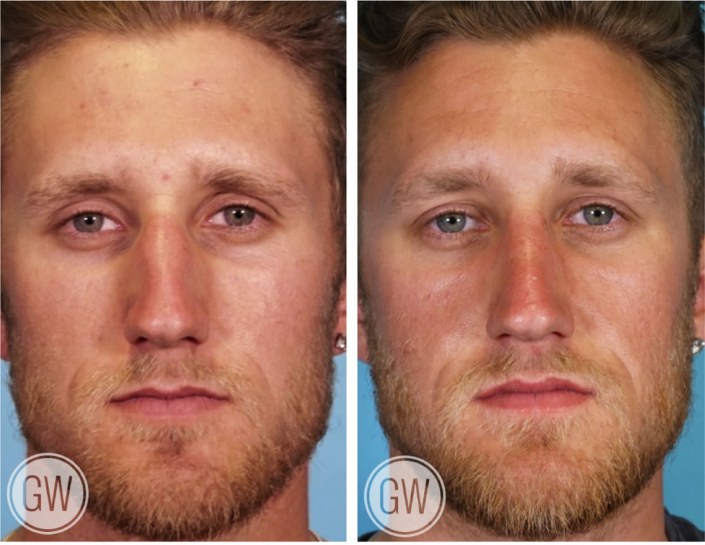 Rhinoplasty + Septoplasty
