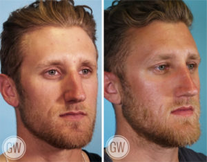 Rhinoplasty + Septoplasty