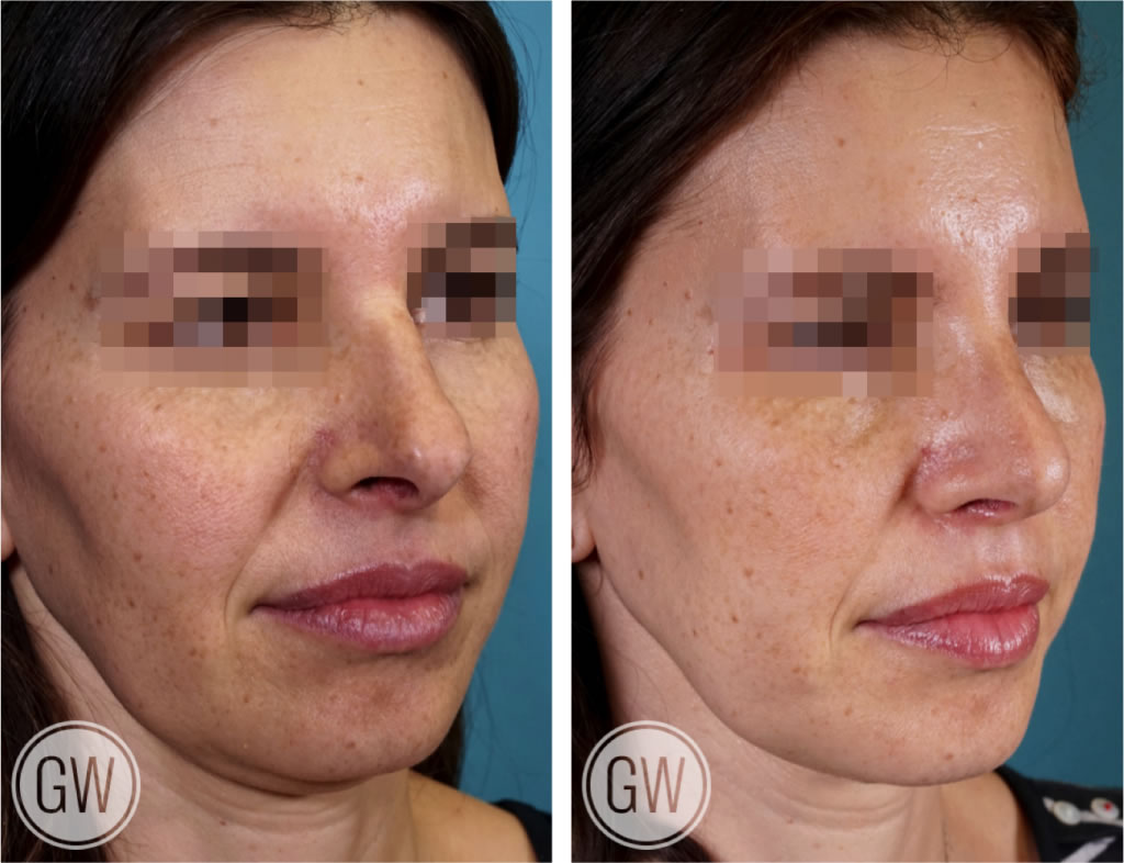 Rhinoplasty + Septoplasty