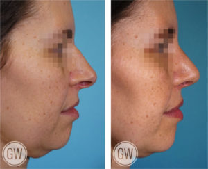 Rhinoplasty + Septoplasty