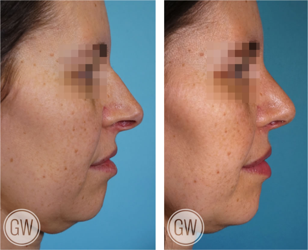 Rhinoplasty + Septoplasty