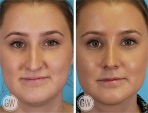 Rhinoplasty + Neck Liposuction