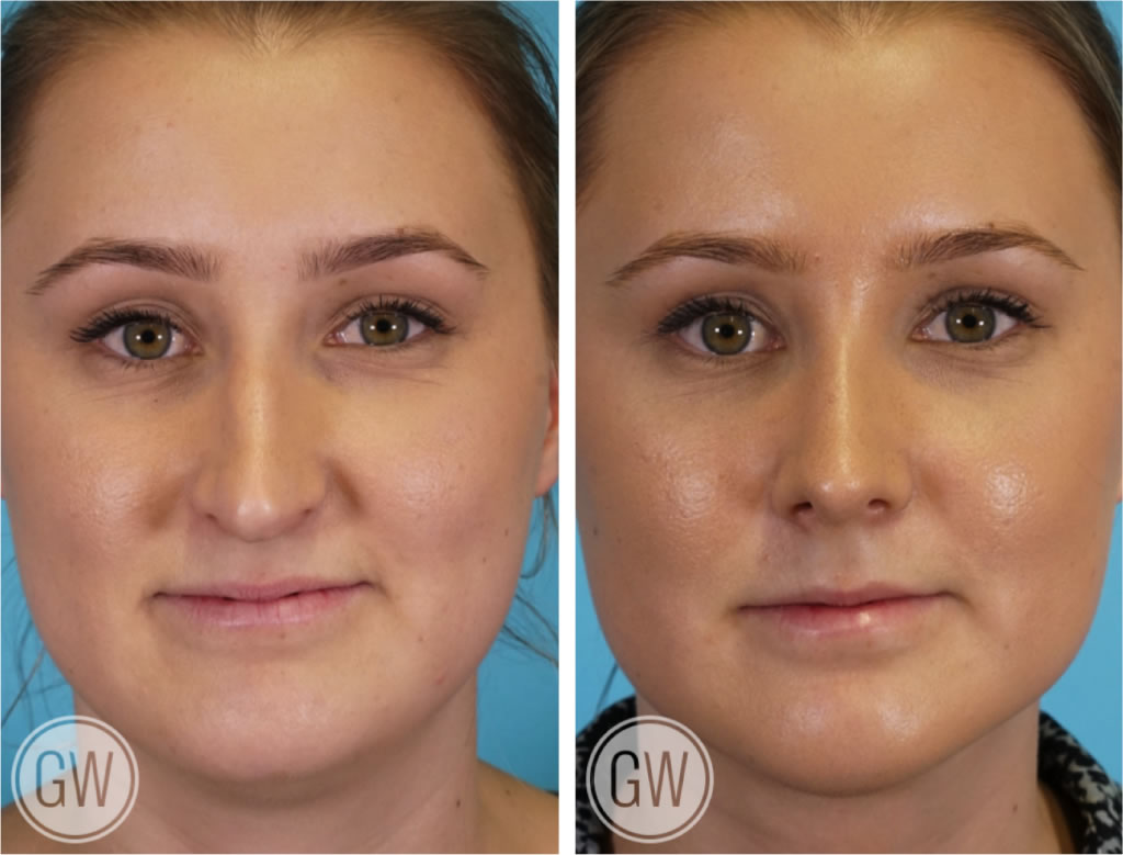 Rhinoplasty + Neck Liposuction