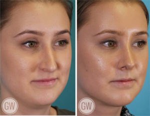 Rhinoplasty + Neck Liposuction