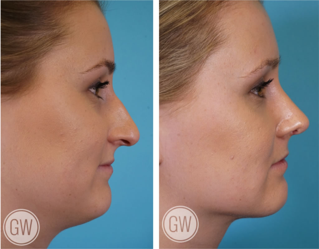 Rhinoplasty + Neck Liposuction