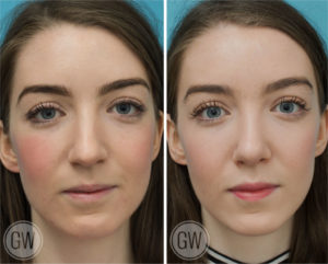 Rhinoplasty