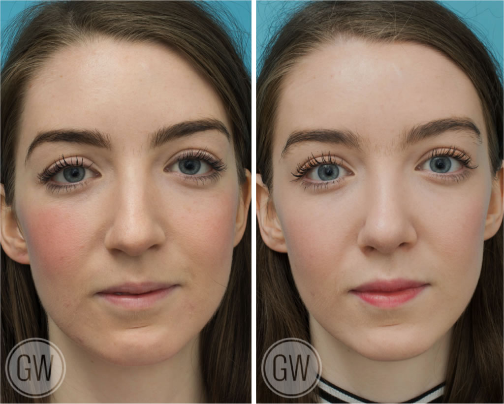 Rhinoplasty
