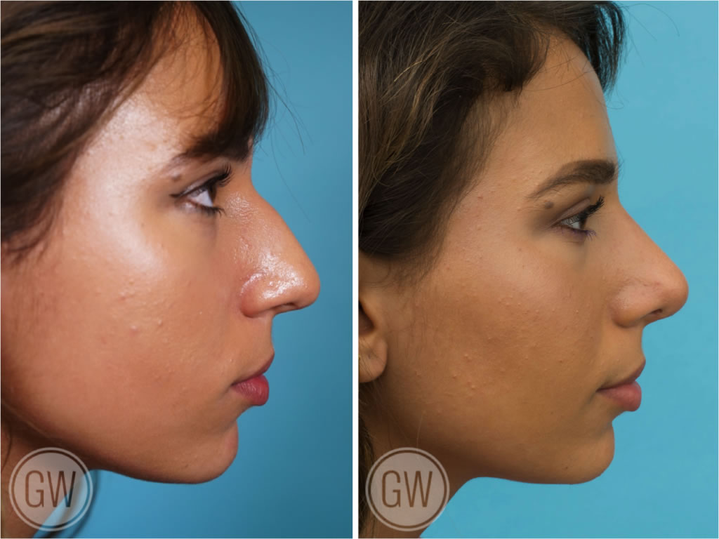 Rhinoplasty + septoplasty + turbinate reduction