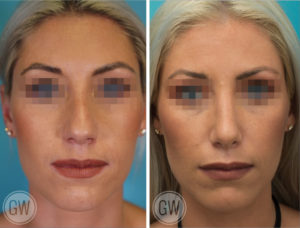 Rhinoplasty