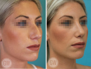 Rhinoplasty