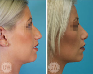 Rhinoplasty