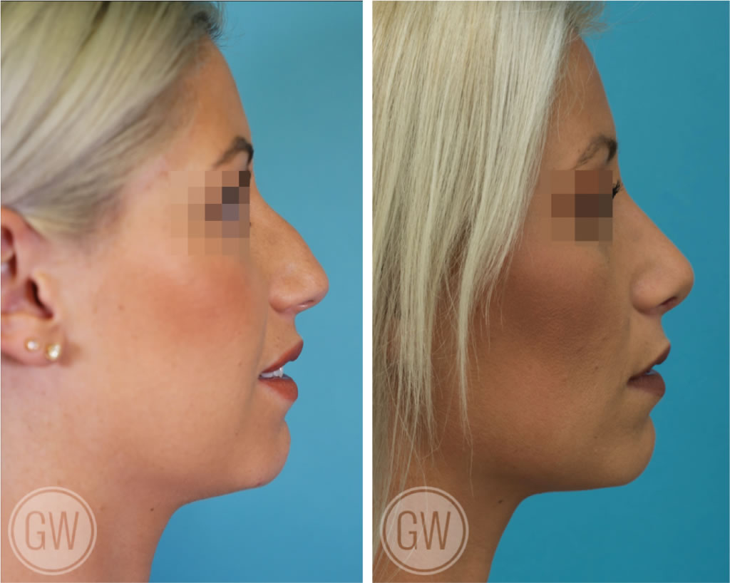 Rhinoplasty