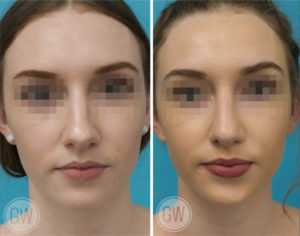 Rhinoplasty