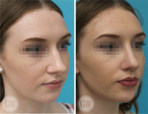 Rhinoplasty