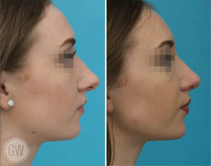 Rhinoplasty
