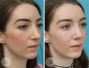 Rhinoplasty