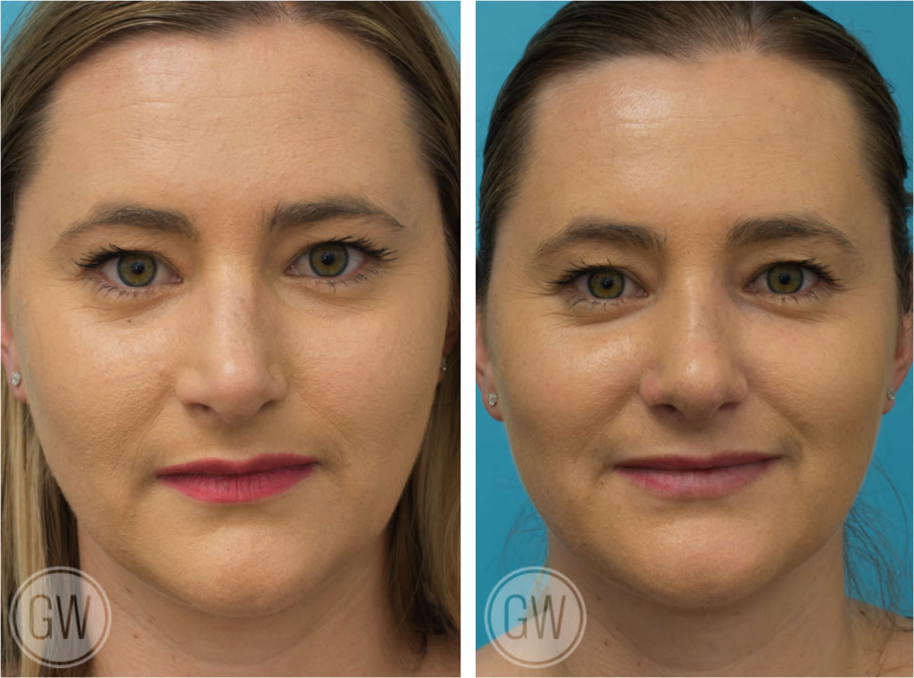 Rhinoplasty + septoplasty + turbinate reduction