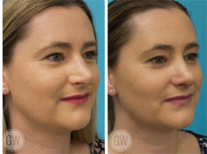 Rhinoplasty + septoplasty + turbinate reduction