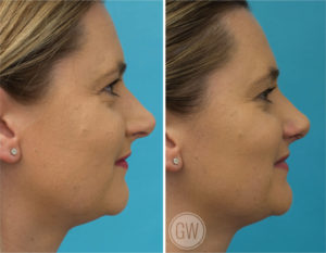Rhinoplasty + septoplasty + turbinate reduction