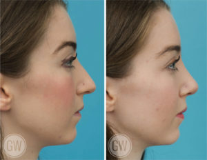 Rhinoplasty