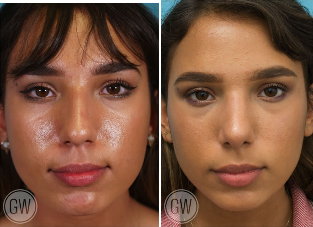 Rhinoplasty Gallery - Rhinoplastyperth