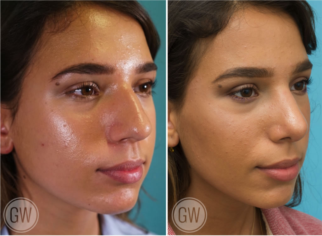 Rhinoplasty + septoplasty + turbinate reduction