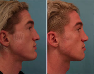 Rhinoplasty + Septoplasty + Reduction genioplasty