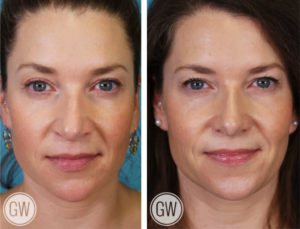 Rhinoplasty + Septoplasty