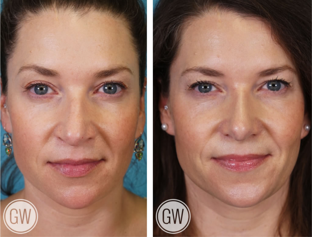 Rhinoplasty + Septoplasty