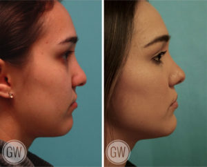 Cleft Rhinoplasty + Upper Lip Fat Grafting